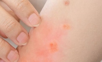 Mpox virus